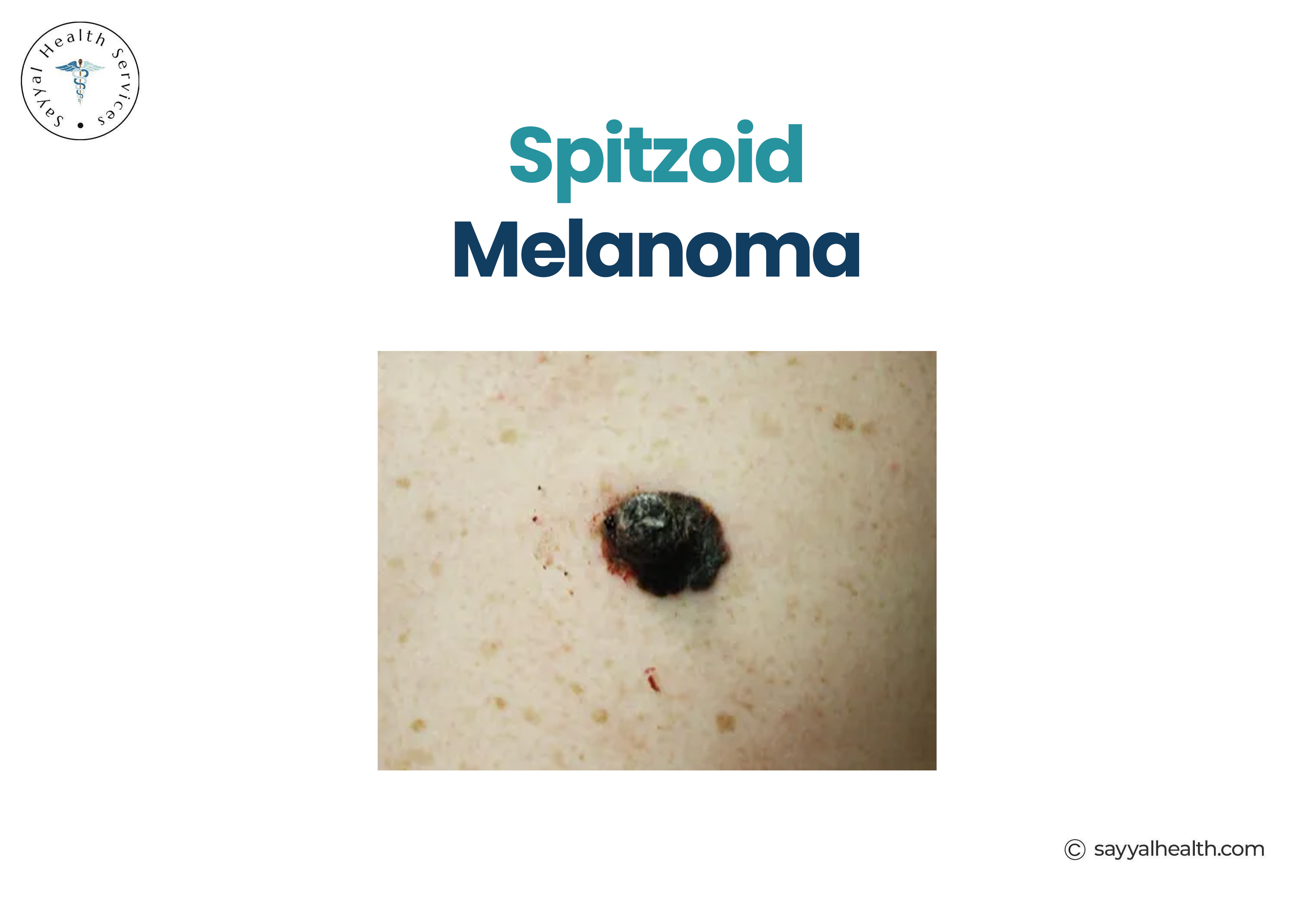 picture of spitzoid melanoma